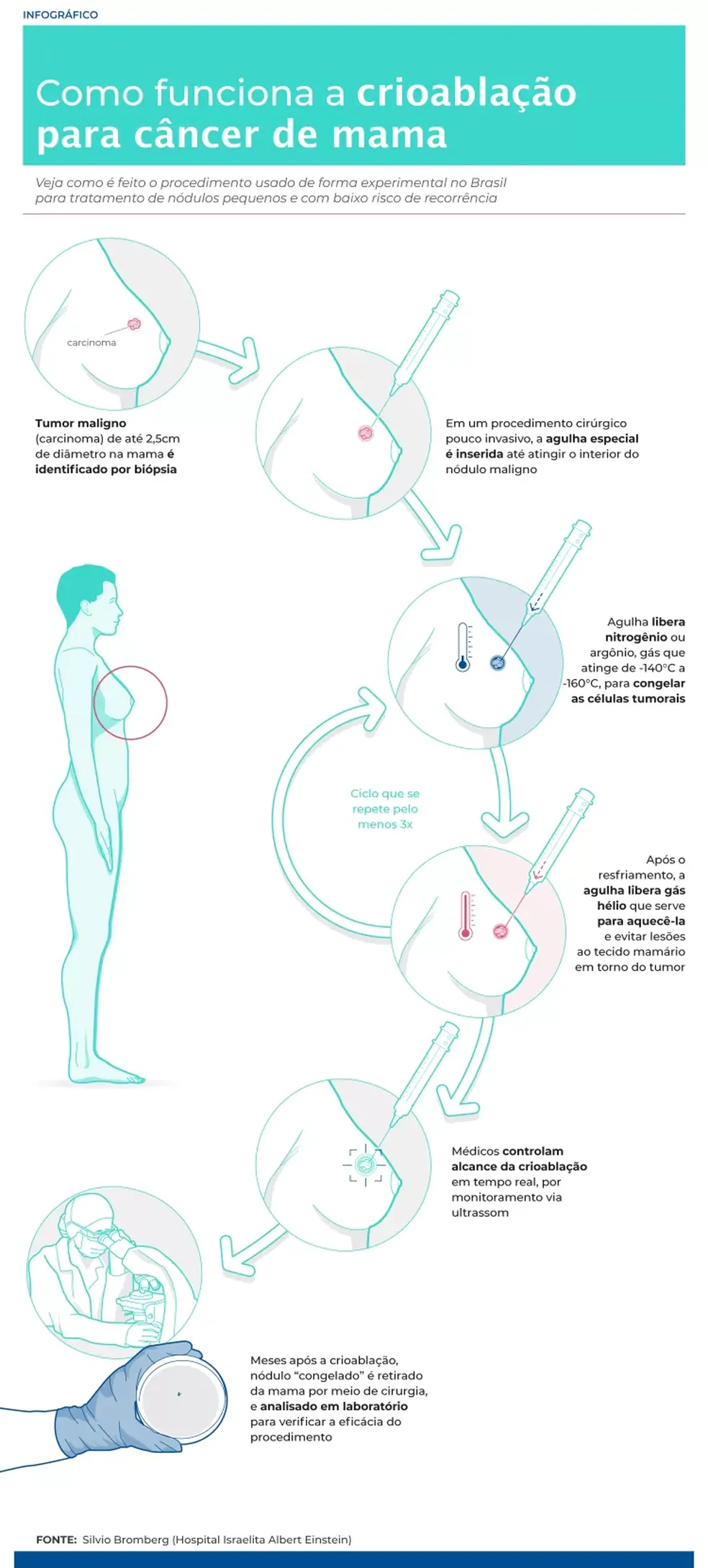 Como funciona a crioablação para câncer de mama — Foto: Agência Einstein