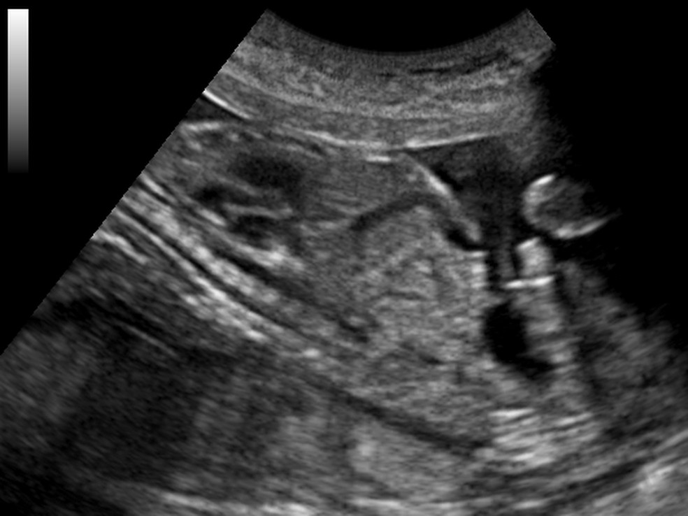 A ultrassonografia utiliza ondas sonoras de alta frequência para criar imagens em tempo real do interior do nosso corpo — Foto: Wikimedia Commons