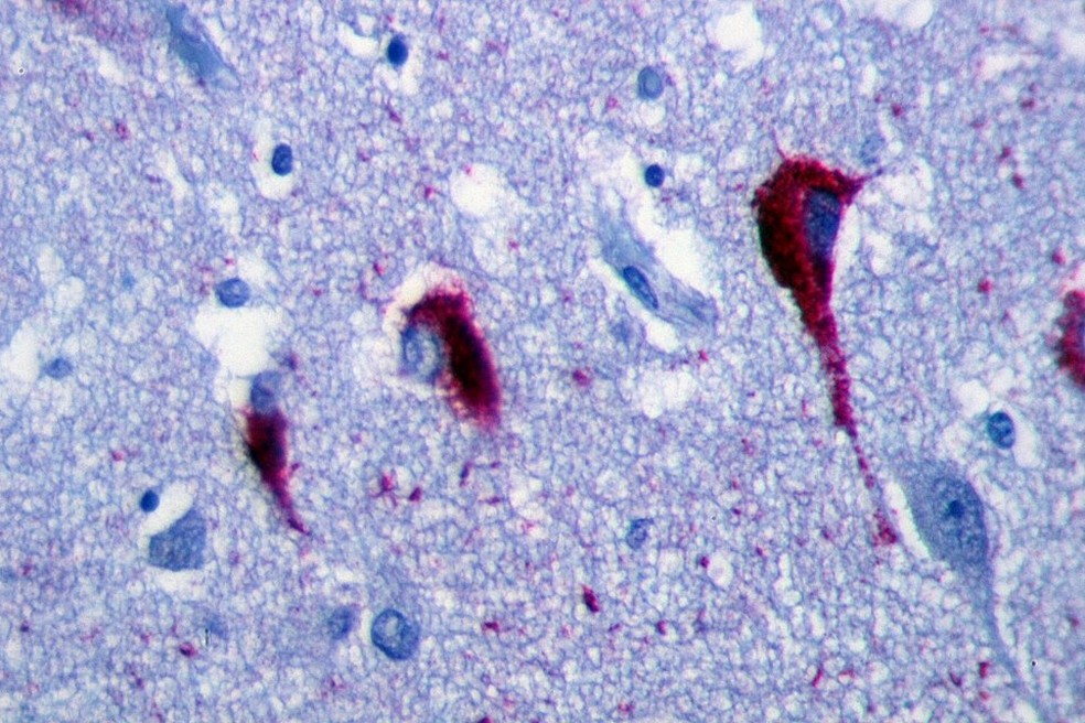 A proteína-tau, estrutura interna que dá forma aos neurônios, sofre alterações químicas, muda de forma, se acumula em emaranhados tóxicos e destrói as células cerebrais, causando a perda de memória e o avanço do Alzheimer — Foto: Wikimedia Commons