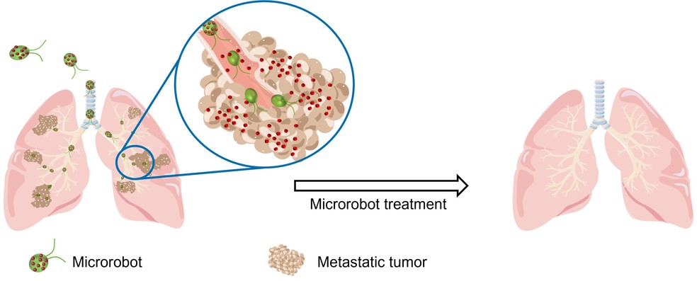 Ilustração dos microrrobôs sendo administrados através da traqueia para tratar tumores metastáticos nos pulmões — Foto: Zhengxing Li