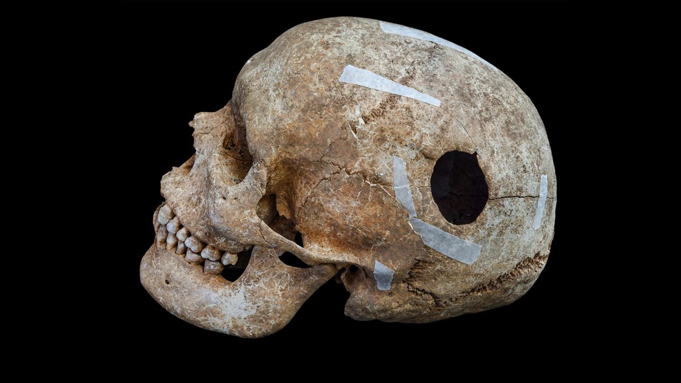 Um dos crânios apresentava evidências de trepanação, uma forma antiga de cirurgia craniana — Foto: David Matzliach/Unidade Arqueológica de Cambridge/Universidade de Cambridge