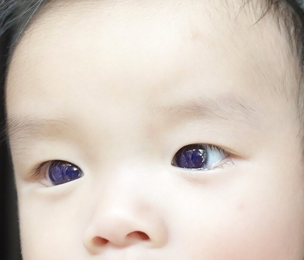 Os olhos castanhos de menino de 6 meses ficaram azul índigo depois que ele recebeu o antiviral favipiravir para tratar Covid-19 — Foto: Paveewan Jiravisitkul et al