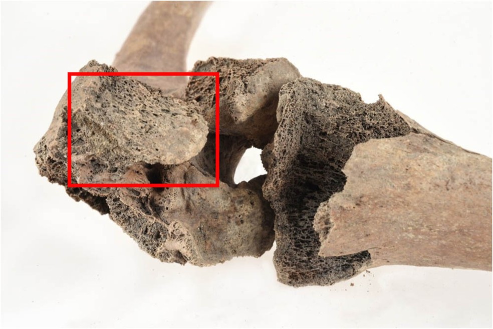 Close do joelho esquerdo com a patela fundida visível à esquerda (caixa vermelha) — Foto: Nelly H Hercberg/Museu Cultural de Lund