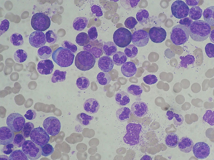 A leucemia mieloide aguda é uma condição agressiva, de evolução rápida e que exige tratamento imediato