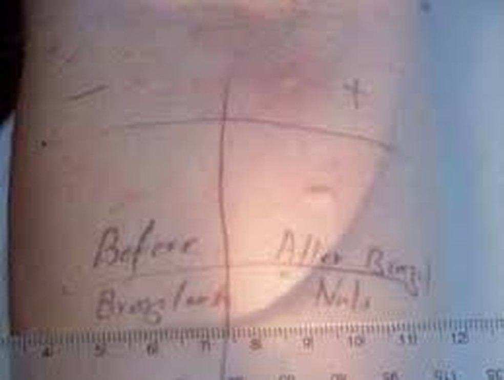 Teste de alergia realizado com o sêmen do namorado da jovem — Foto: AS Bansal et.al