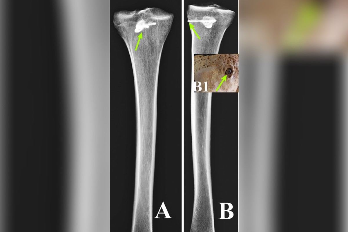 Estudo reconta história de homem do século 3 que morreu com flecha alojada no corpo