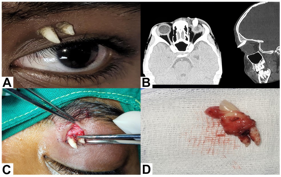 Após meses de inchaço na região entre a pálpebra e a sobrancelha, jovem indiano procurou ajuda médica. Uma tomografia revelou o dente ectópico, que foi então removido em cirurgia — Foto: Meghana Tanwar, DNB, FRCS (Ophth) ∙ Vedant Sharma, MBBS2 ∙ Usha Kim, DO, DNB