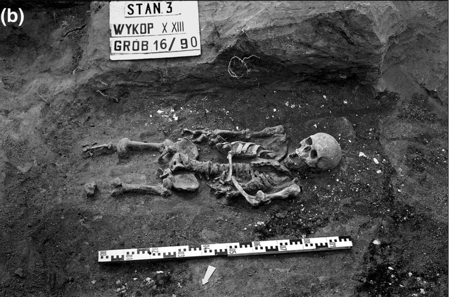Homem enterrado na Polônia durante a Idade Média tinha dois tipos de nanismo