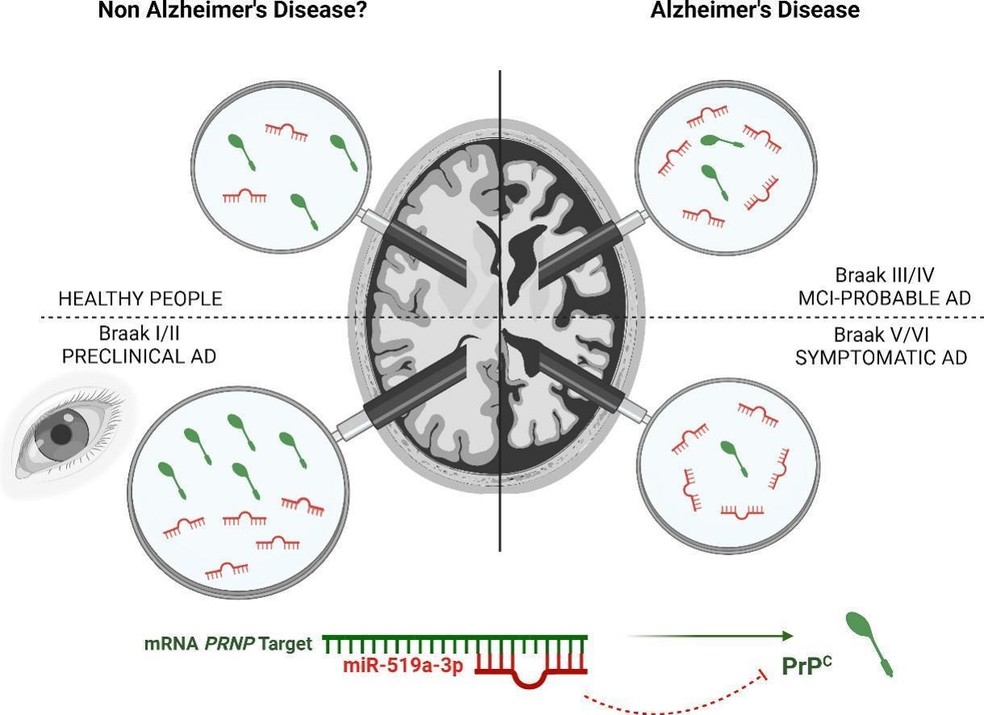 Os resultados das anlises mostraram diminuio da produo da PrPC durante a progresso do Alzheimer como resultado do estudo  Foto: Biochimica et Biophysica Acta (BBA)