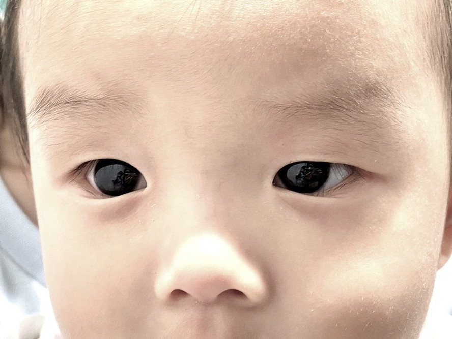 Mãe notou uma descoloração dos olhos da criança 18 horas após a terapia com antiviral