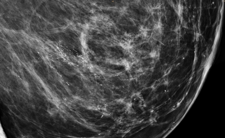 Mulheres com câncer de mama têm melhor prognóstico do que há 20 anos
