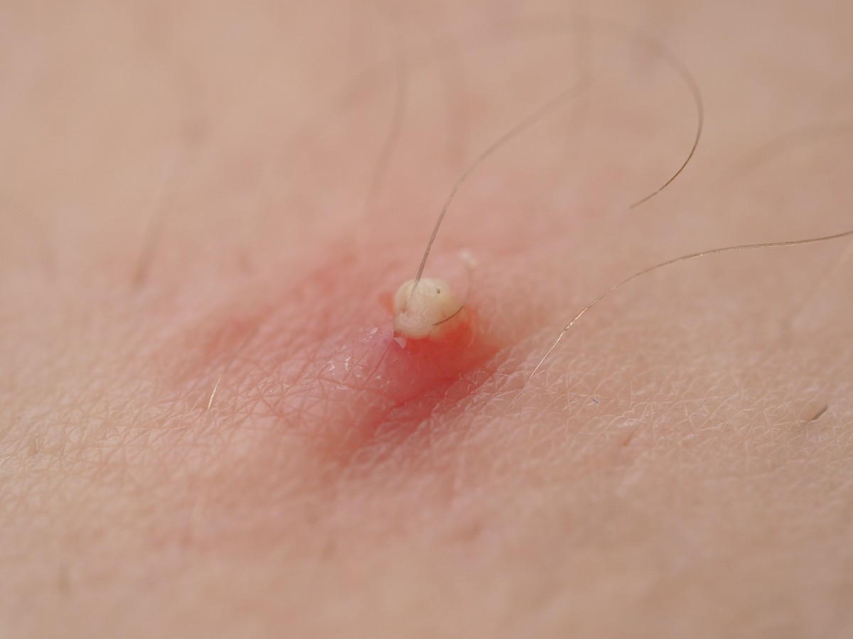 Por que tanta gente gosta de assistir a vídeos de espinhas e cravos?