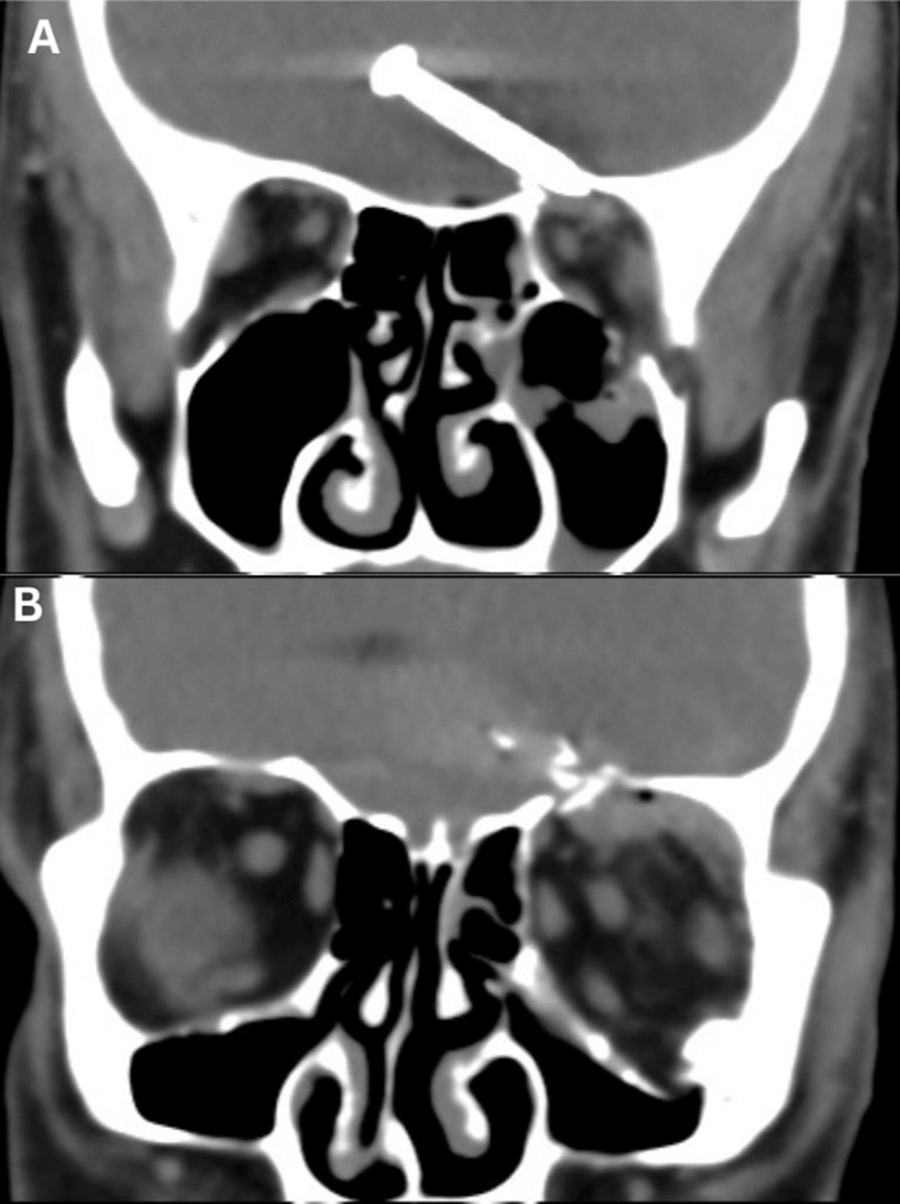 Tomografia computadorizada do crânio sem contraste (corte coronal) mostrando o prego (A) e fraturas do teto e assoalho da órbita esquerda (B) — Foto: Tze Huei Kee et.al