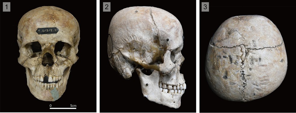 Crânios do antigo povo japonês com deformações cranianas — Foto: Seguchi et al