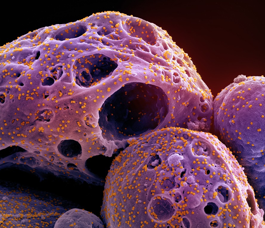 Micrografia eletrônica de varredura de uma célula (roxa) infectada com a cepa ômicron de partículas do vírus SARS-CoV-2 (laranja)