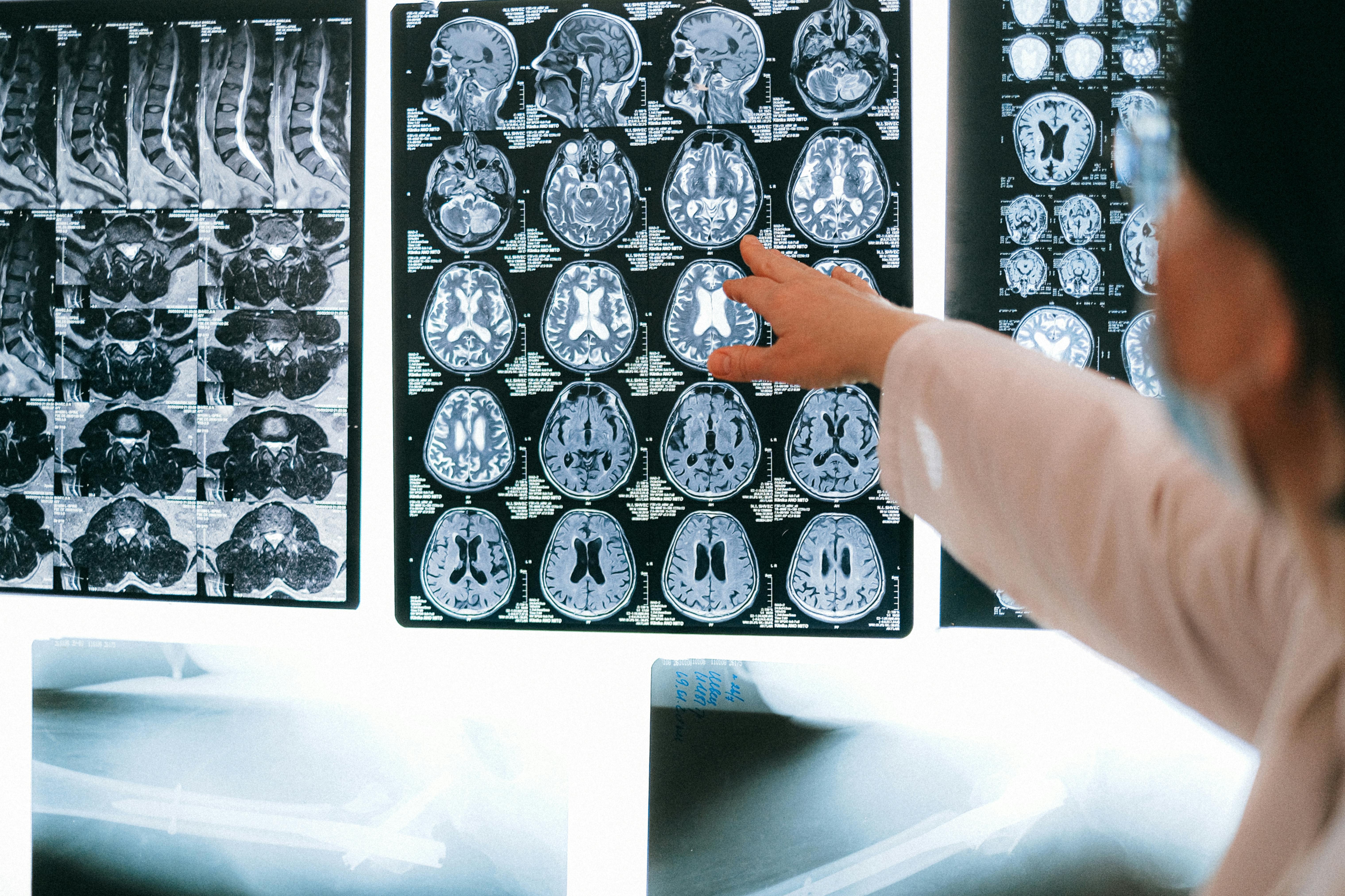 Ilustração de células cerebrais em processo de envelhecimento
