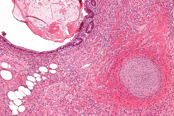 Teratoma: entenda o que é o tumor que pode ter dente, unhas e cabelo
