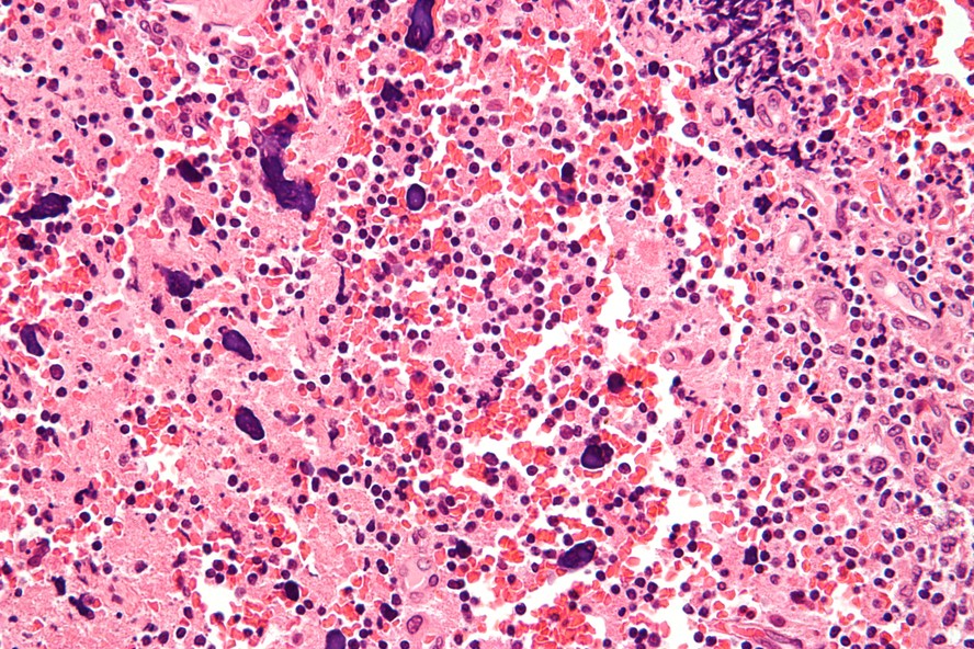 Células de uma linfadenopatia no lúpus eritematoso sistêmico (LES), uma atividade cutânea causada pelo lúpus