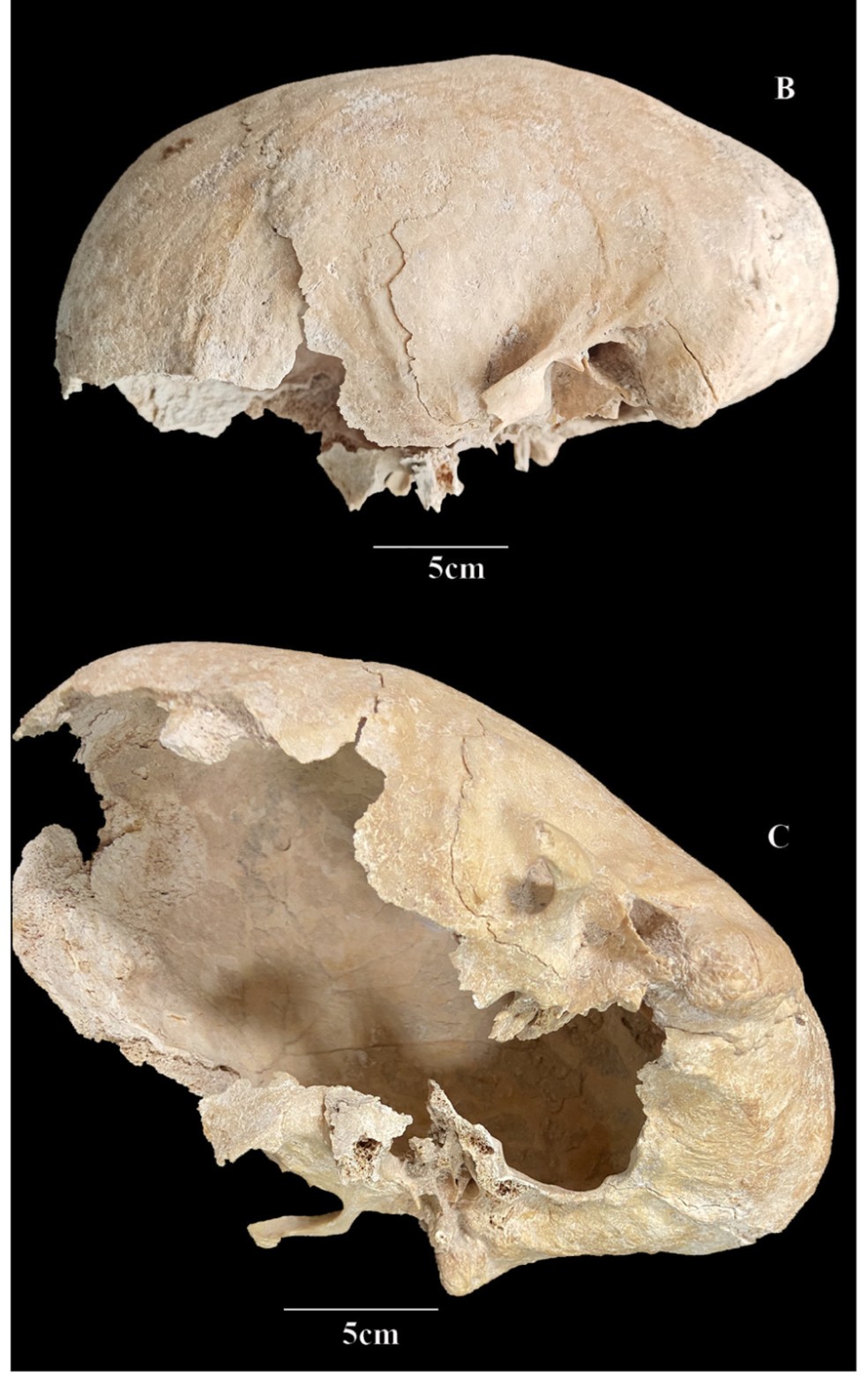 Apesar da condição genética potencialmente fatal, o homem sobreviveu e supostamente tinha um estilo de vida ativo como a de um guerreiro — Foto: Carme Rissech/Heritage