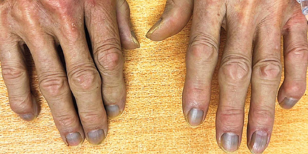 Argiria: conheça a estranha doença que deixou homem de 84 anos cinza