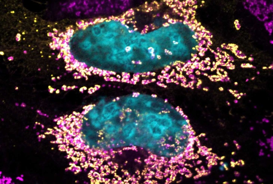 Células humanas expressando a proteína MceF da Coxiella. A cor azul mostra o núcleo das células; em rosa, as mitocôndrias e, em amarelo, a proteína MceF. A figura evidencia a colocalização de MceF com as mitocôndrias celulares.