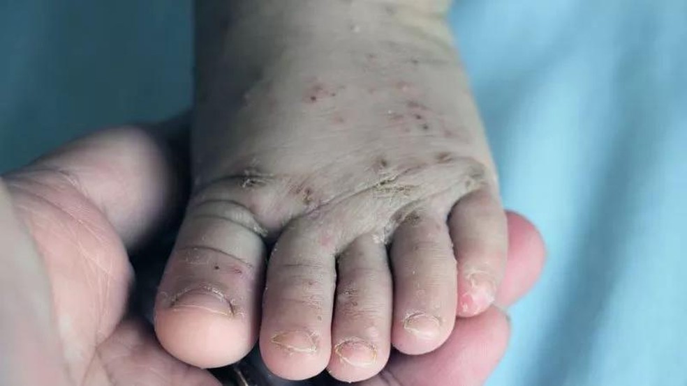 Sarna humana: conheça os sintomas e tratamentos para a escabiose (Foto: Ministério da Saúde) — Foto: Galileu