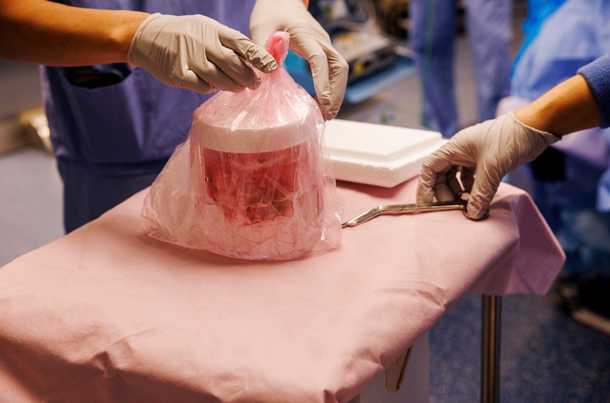 Rim de porco falha antes de transplantado quebrar recorde nos EUA