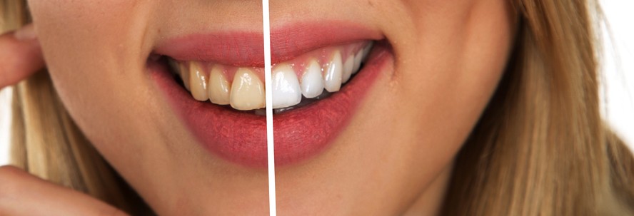 Imagem de um sorriso mostrando um contraste em coloração do dente