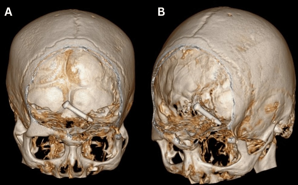 Tomografia reconstruída tridimensional do cérebro mostrando a haste penetrada pelo prego no teto orbital esquerdo e alojada nos lobos frontais — Foto: Tzé Hui Kee et.al / Cureus
