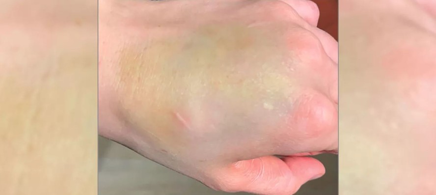 Hematoma esverdeado na mão de mulher era tumor raro