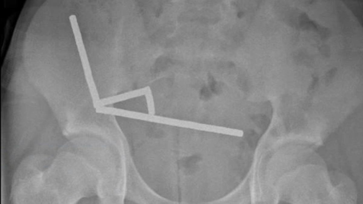 Jovem neozelandês perde parte do intestino após engolir quase 200 ímãs