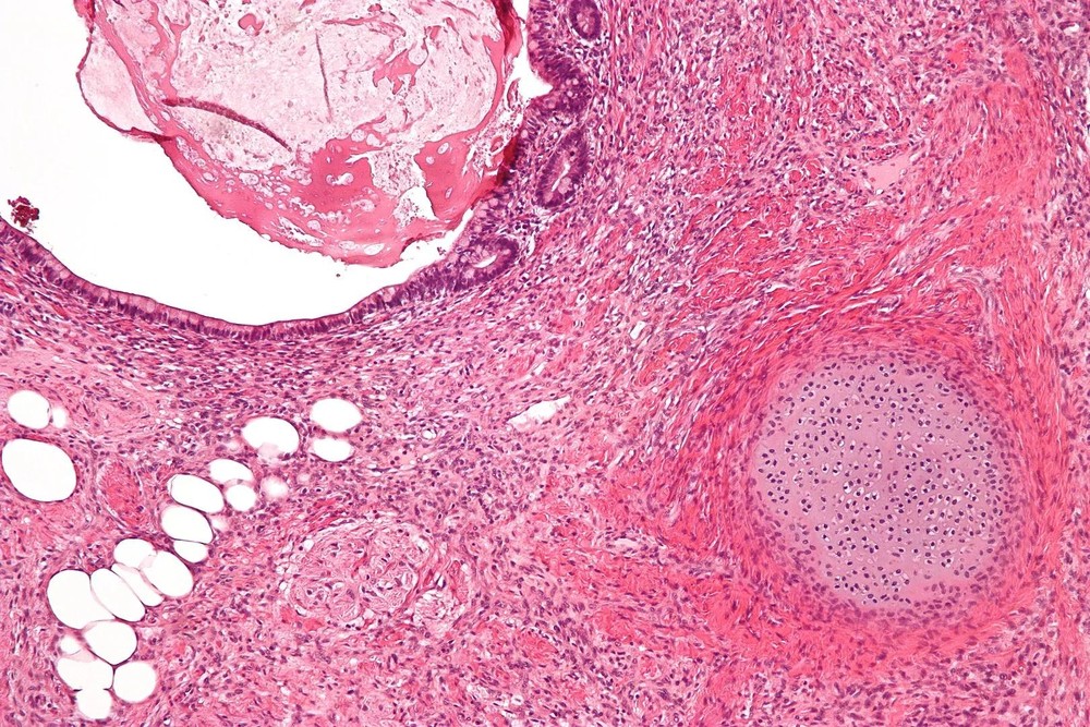 Teratoma: entenda o que é o tumor que pode ter dente, unhas e cabelo