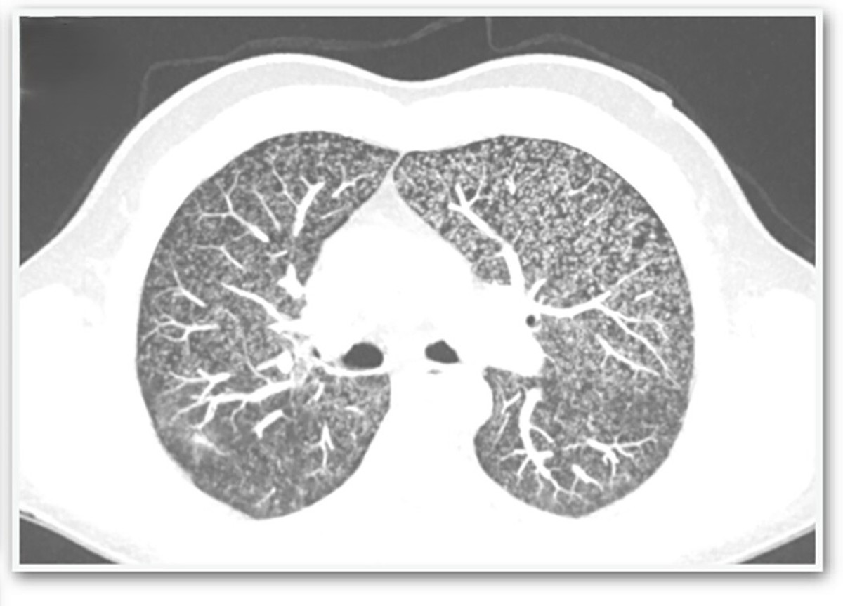 Irlandês de 57 anos contrai tuberculose rara no pênis; entenda os efeitos