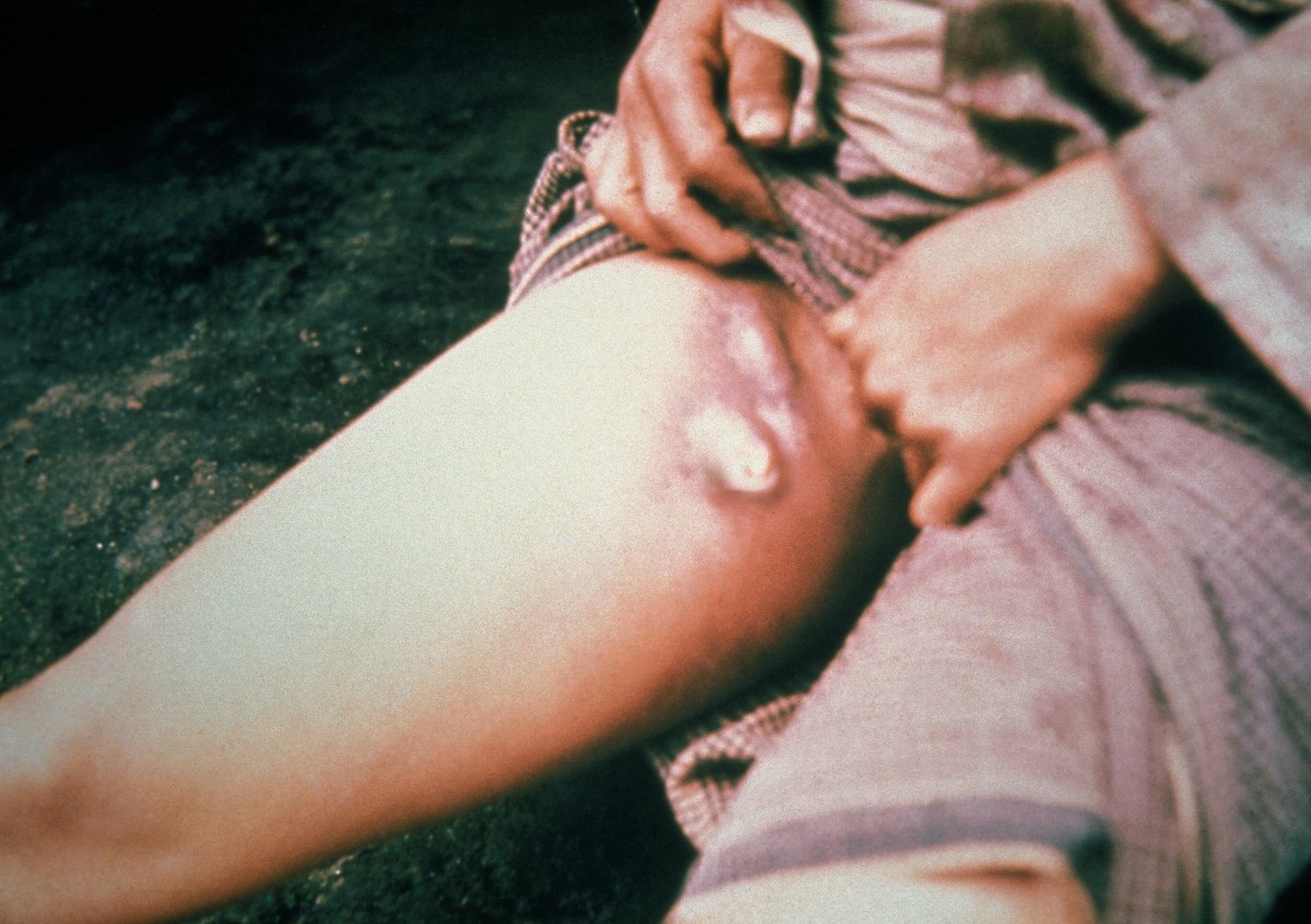 Como a bactéria da peste negra conseguiu sobreviver até os tempos modernos? Ficando menos letal