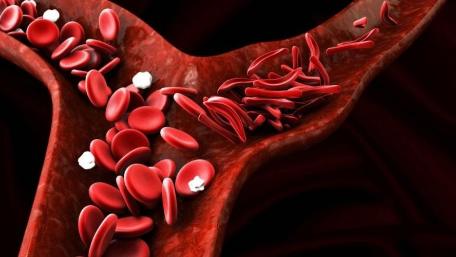 Transplante de células-tronco melhora imunidade contra anemia falciforme