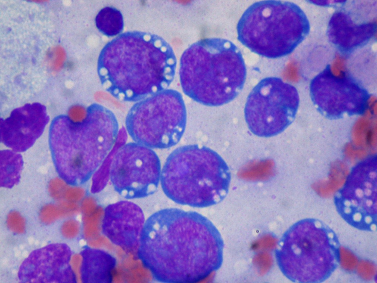 Câncer não é tudo igual: entenda a diferença entre tumor oncológico e hematológico