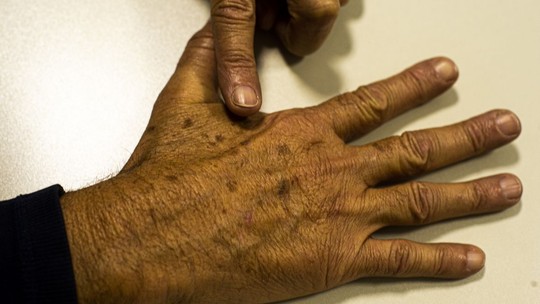 Conheça a tecnologia para tratar câncer de pele aprovada para o SUS
