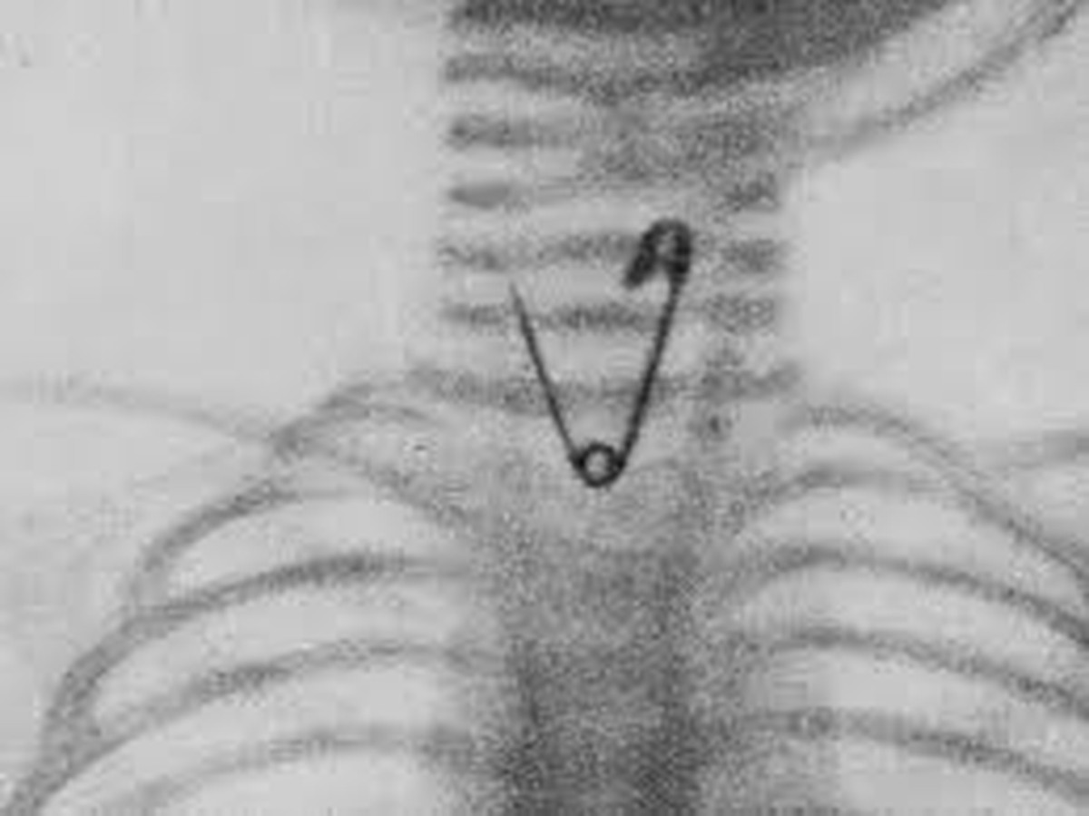 De agulhas a projéteis: a tecnologia que encontra metais perdidos no corpo