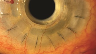 Aspecto físico do olho após a cirurgia e implantação da prótese — Foto: Magalhães et al.