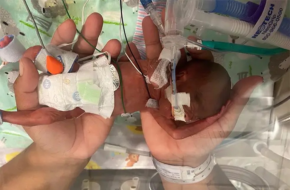 Curtis logo após seu nascimento, com um peso equivalente a uma bola de futebol — Foto: Guinness World Records