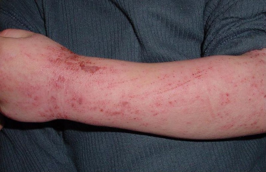 Caso de dermatite atópica no braço de uma criança