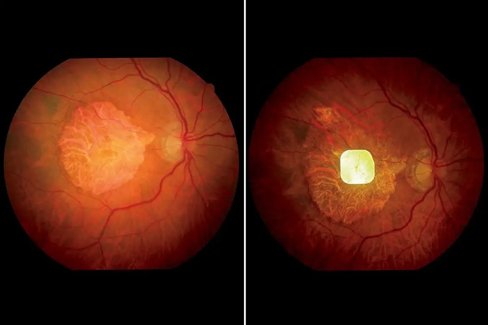 Olho de um participante do estudo sem (esquerda) e com o implante de retina (direita) — Foto: Science Corporation