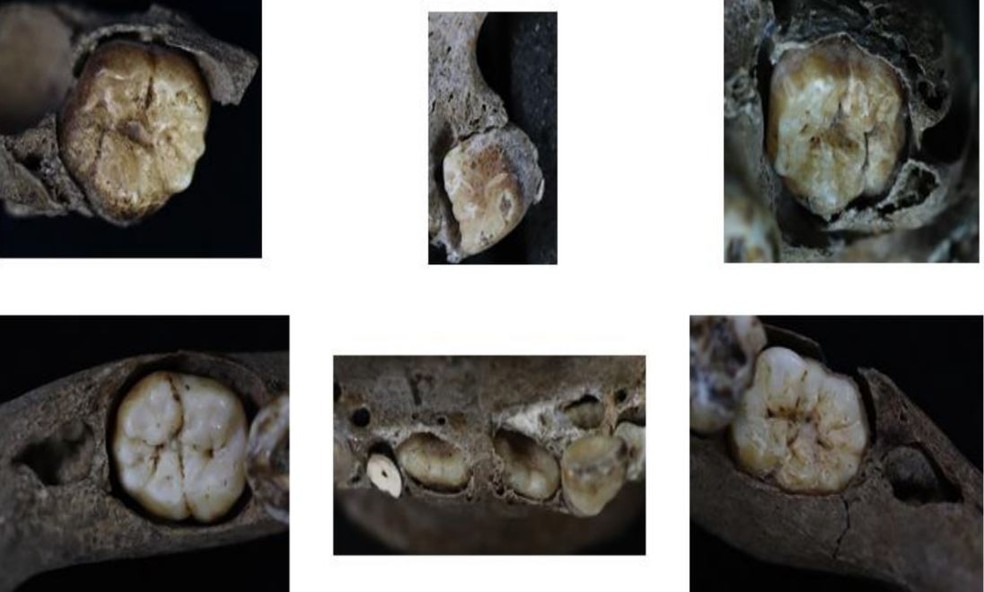 Dentes permanentes da criança B20 apresentam alterações anatômicas comumente presentes em casos de sífilis congênita — Foto: Rodrigo Oliveira et.al 