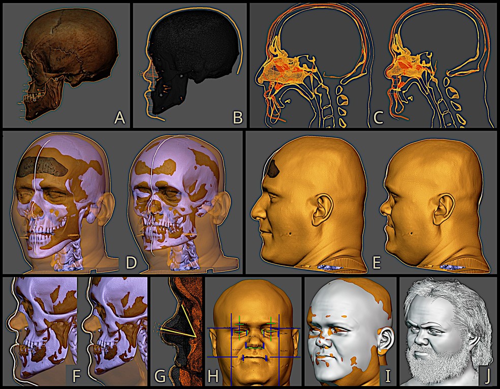 Evolução do procedimento de aproximação facial — Foto: Moraes et al