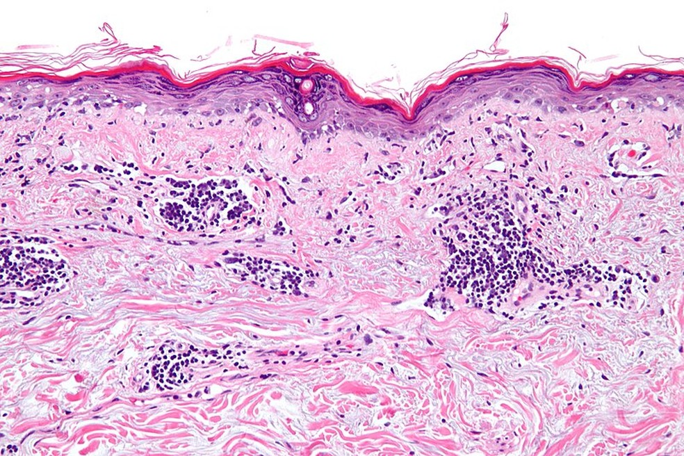 Micrografia de alta ampliaçãode uma dermatite — Foto: Wikimedia Commons