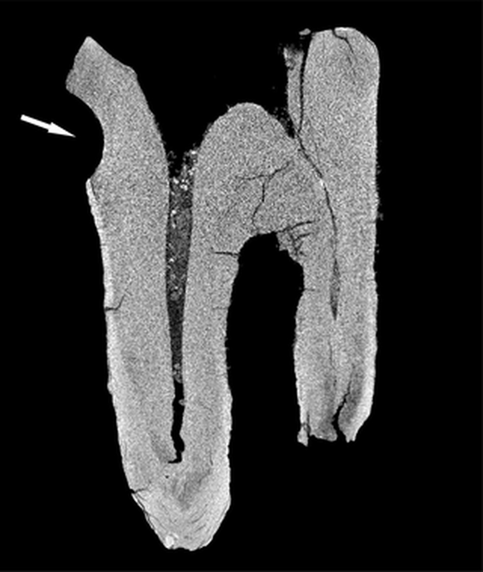 Tomografia computadorizada do molar de neandertal; a seta indica um sulco feito por instrumentos de pedra — Foto: PLOS One