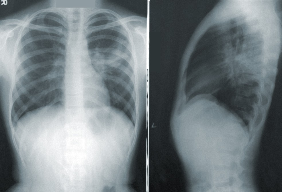 Os especialistas recomendam que, nos exames de rotina, fumantes e ex-fumantes passem por tomografias para verificar a existência de tumores nos pulmões — Foto: Unsplash
