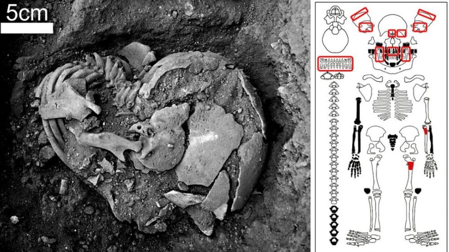 Fotografia da exumação da criança B20 e desenho do esqueleto evidenciando os ossos acometidos (vermelho) por alterações morfológicas causadas pela sífilis congênita