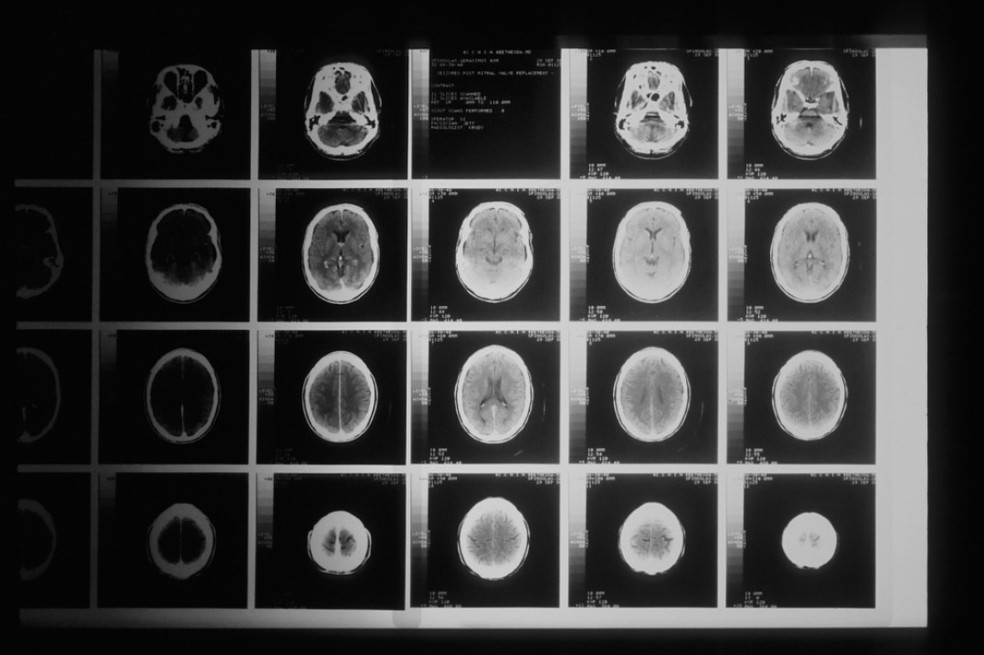O autismo diagnosticado tardiamente mostra perfil genético mais próximo do TDAH e da depressão, com desafios sociais que frequentemente se intensificam durante a adolescência. — Foto: NCI/Unplash