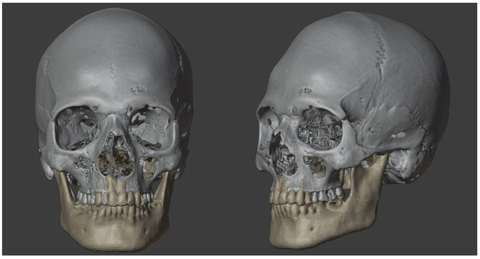 Conclusão do crânio com a mandíbula escolhida — Foto: Moraes et al